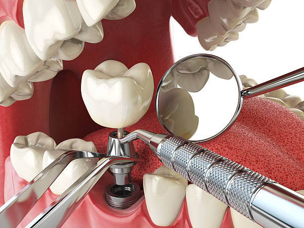 Best Emergency Broken Tooth Repair in Great Falls, VA